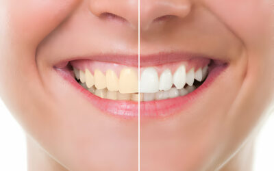 Your DIY Guide to Teeth Whitening Safety – Everything You Need to Know!