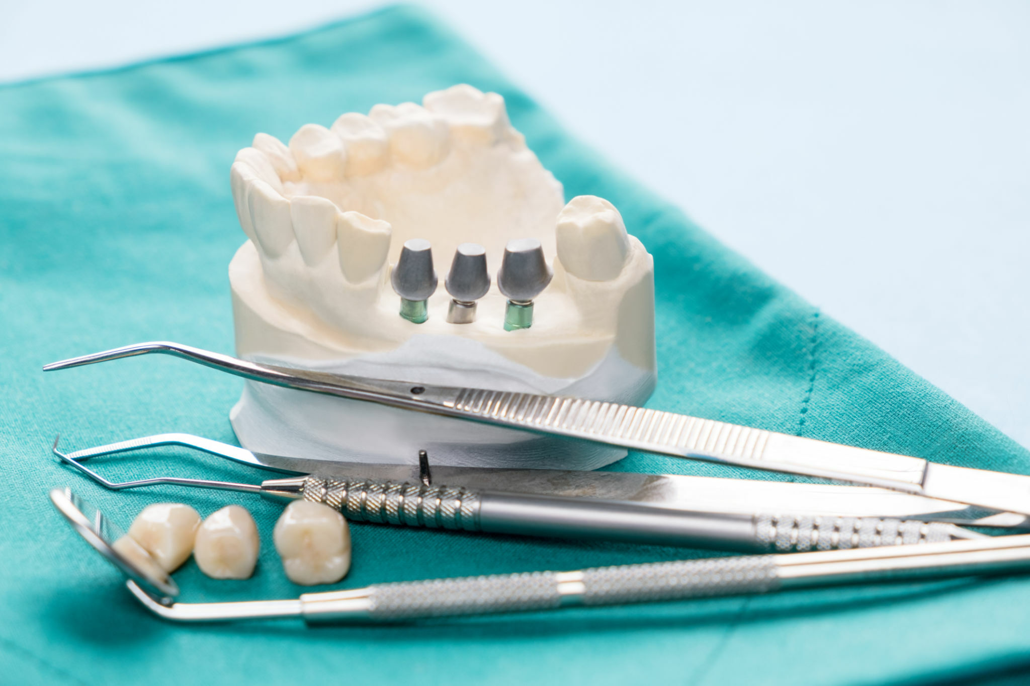 A Comprehensive Guide To Dental Implants In Tupelo, MS_3