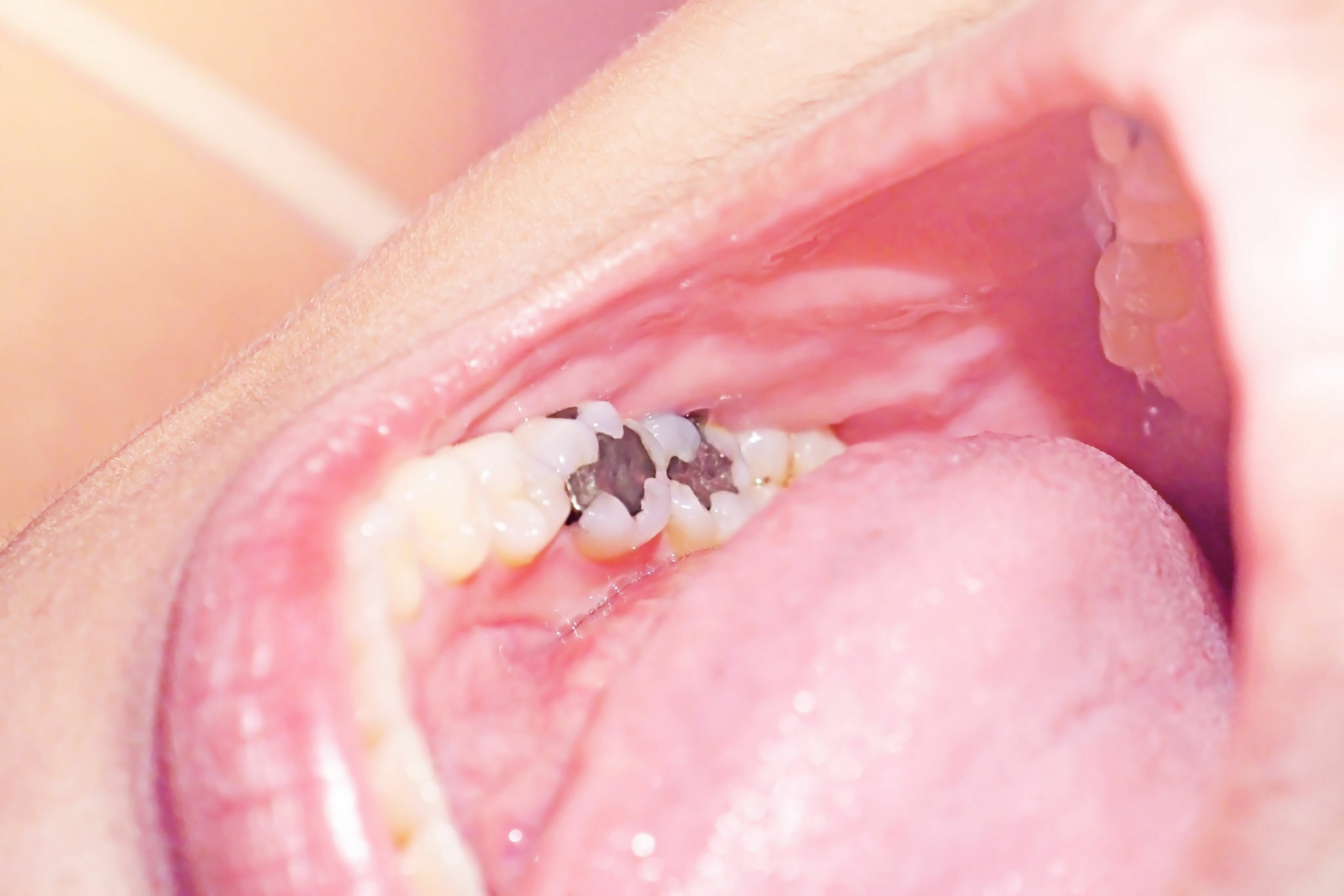 Dos And Don'ts After Tooth Filling: Your Guide To Better Recovery_2