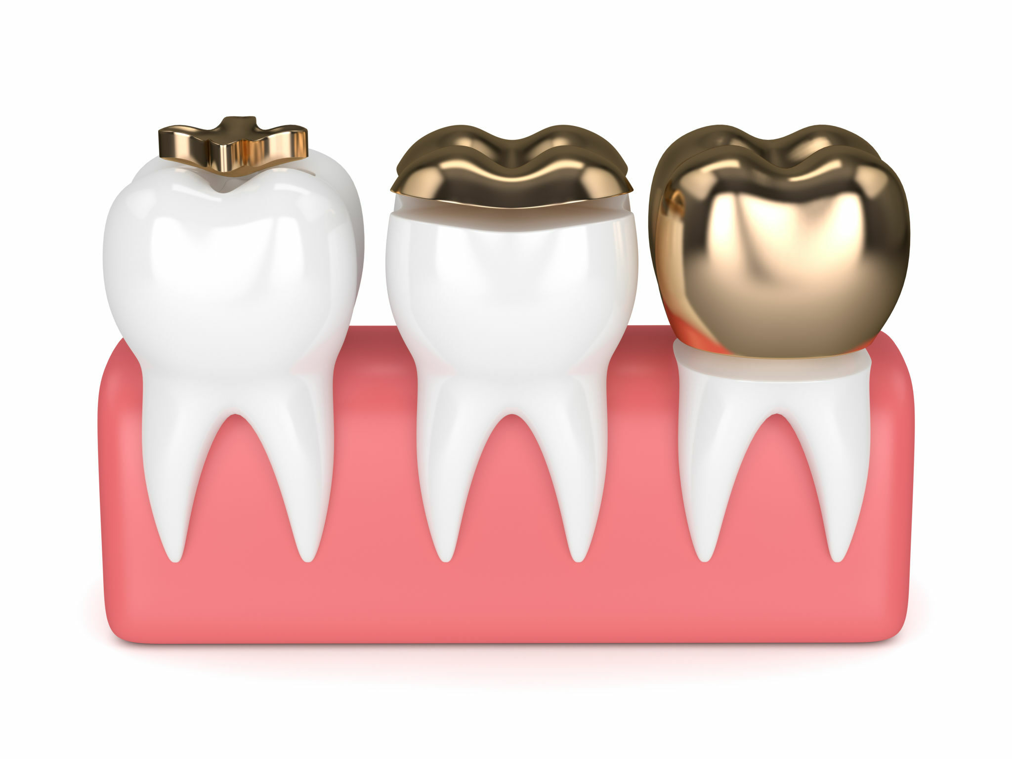 Dos And Don'ts After Tooth Filling: Your Guide To Better Recovery_3