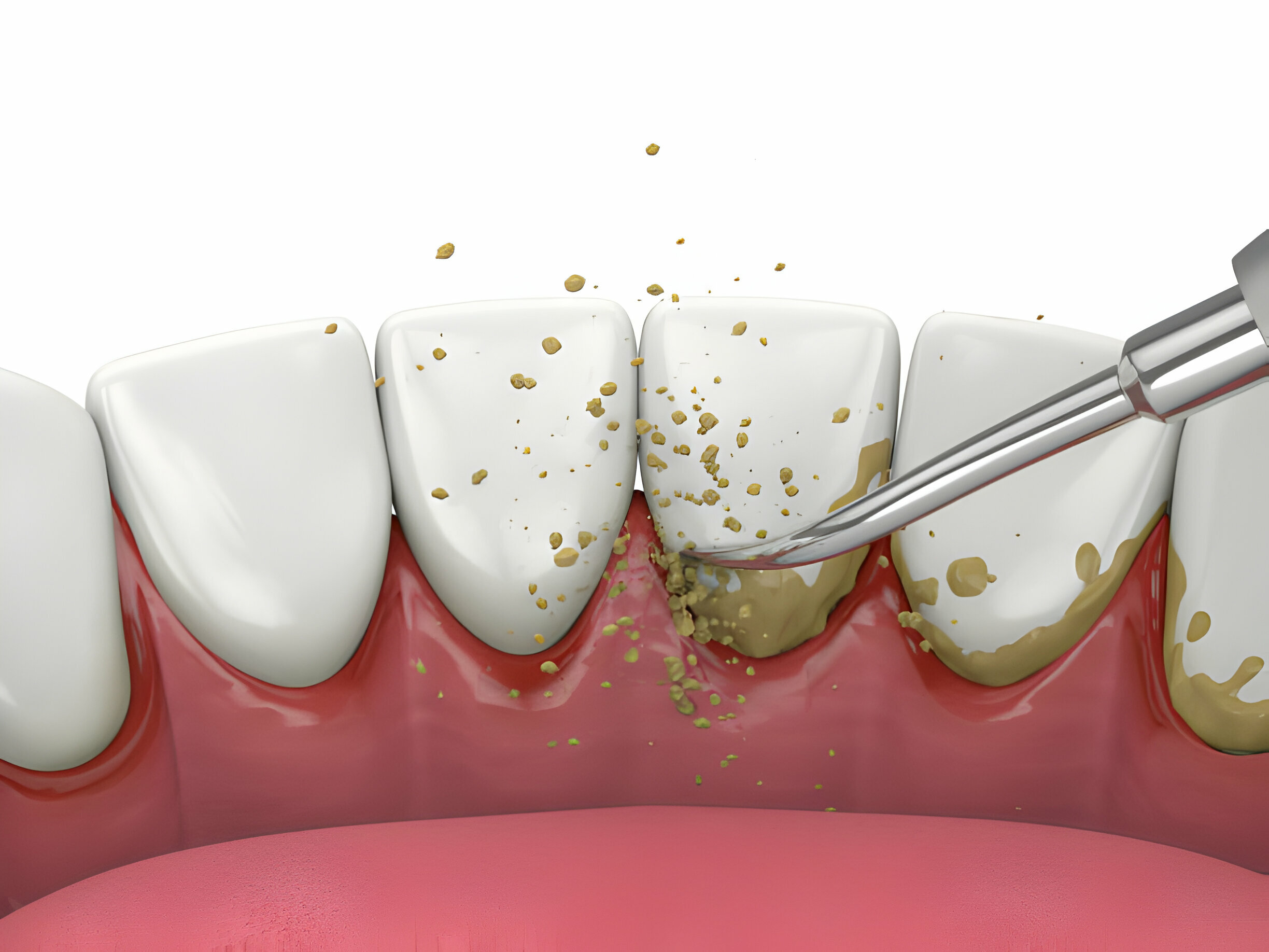 Explore 7 Key Facts About Gum Disease To Improve Your Oral Health_2