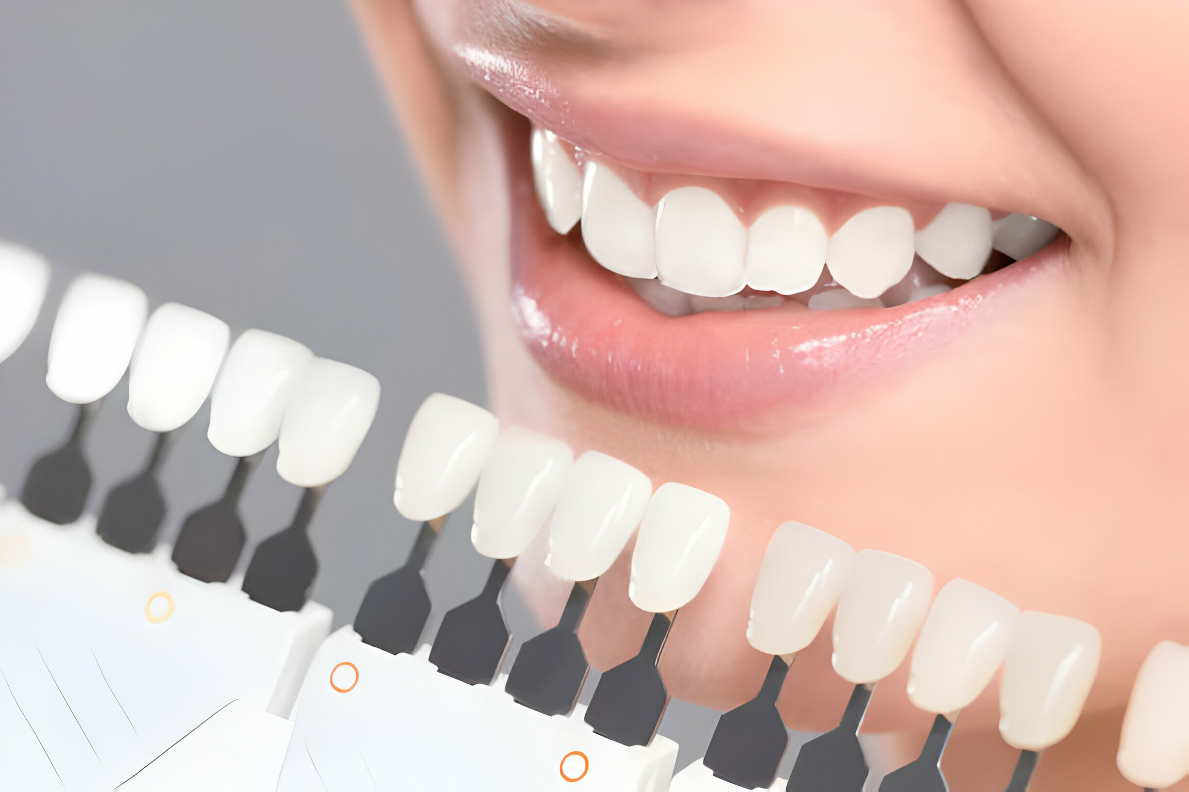 Tupelo EMAX Veneers: Find Your Perfect Smile With A Local Dentist_1