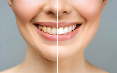 The Link Between Diet and Tooth Whitening: Foods to Avoid and Consume