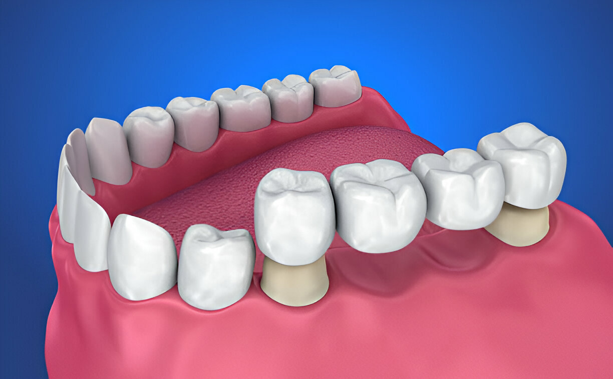 Dental Crowns for Damaged Teeth: Solutions and Benefits_1