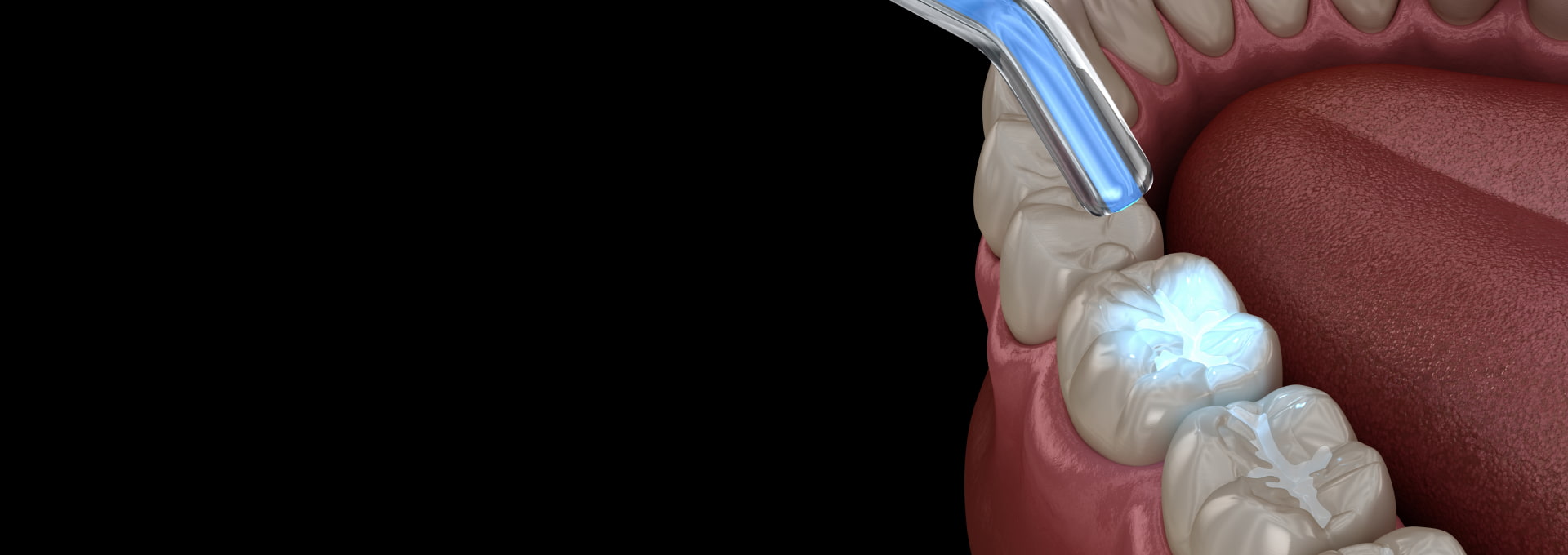 Dental Fillings Banner Image